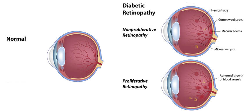 Chart Showing a Healthy Eye Compared to One With Diabetic Retinopathy