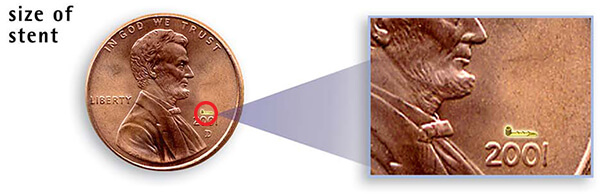 Showing the size of an istent on a penny