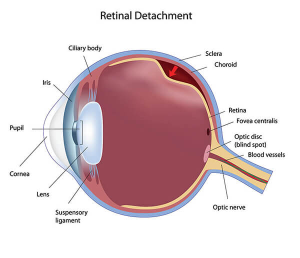 Chart Showing Retinal Detachment in the Eye